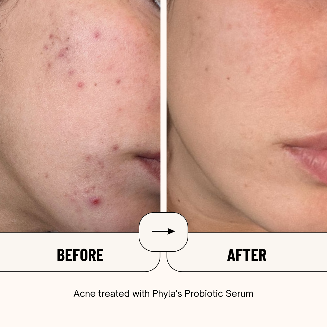 Acne-Fighting Probiotic Serum (60 Day Supply) by Phyla Skincare